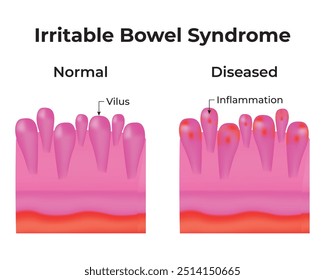 Irritable Bowel Syndrome Science Design Vector Illustration Diagram