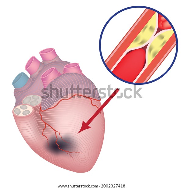 Ischemia Heart Vascular Atherosclerosis Damage Coronary Stock Vector ...