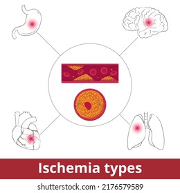 Ischemia types. Visualization of restriction in blood supply caused by problems with blood vessels due to vasoconstriction, thrombosis, or embolism.