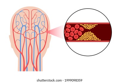 Ischemic brain stroke, arteriosclerosis in human head silhouette. Cholesterol in blood vessels. Fat cells in vein and artery. High ldl and hdl level. Blocked vascular concept flat vector illustration.