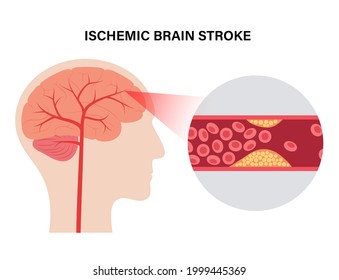 Ischemic brain stroke, arteriosclerosis in human head silhouette. Cholesterol in blood vessels. Fat cells in vein and artery. High ldl and hdl level. Blocked vascular concept flat vector illustration.