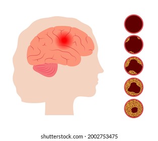 Ischemic brain stroke, arteriosclerosis in human head silhouette. Cholesterol in blood vessels. Fat cells in vein and artery. High ldl and hdl level. Blocked vascular concept flat vector illustration.