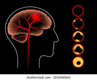 Ictus cerebral isquémico, arteriosclerosis en silueta de cabeza humana. Colesterol en los vasos sanguíneos. Células grasas en vena y arteria. Alto nivel ldl y hdl. Ilustración vectorial plana de concepto vascular bloqueada.