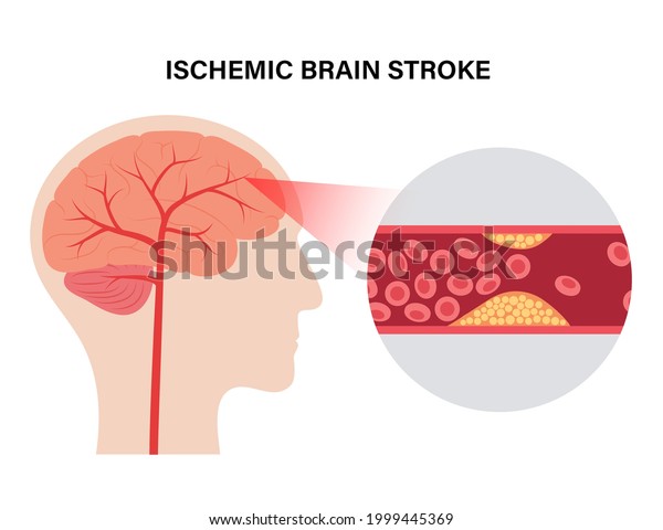 虚血性脳卒中 ヒトの頭シルエットに動脈硬化 血管内のコレステロール 静脈と動脈 の脂肪細胞 高ldlとhdl値 ブロックされた血管のコンセプトのフラットベクターイラスト のベクター画像素材 ロイヤリティフリー