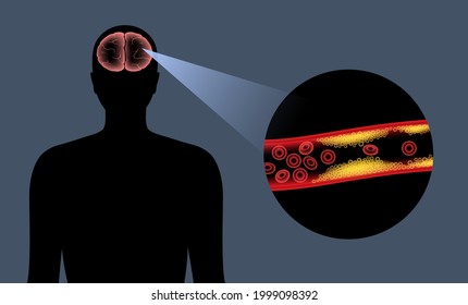 Ictus cerebral isquémico, arteriosclerosis. Infarto, tia, concepto cva. Colesterol en los vasos sanguíneos. Células grasas en vena y arteria, niveles altos de ldl y hdl. Ilustración vectorial plana de concepto vascular bloqueada