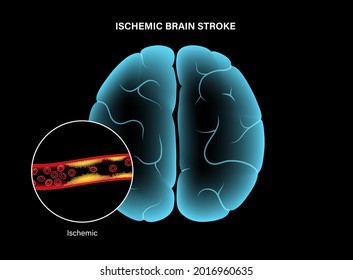 Ictus cerebral isquémico, arteriosclerosis. Infarto, tia, concepto cva. Colesterol en los vasos sanguíneos. Células grasas en vena y arteria, niveles altos de ldl y hdl. Ilustración vectorial plana de concepto vascular bloqueada