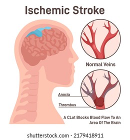 Ischemic Brain Stroke Concept. Thrombus In The Cerebral Artery Preventing Brain Tissue From Getting Oxygen And Nutrients. Emergency Medical Care. Flat Vector Illustration