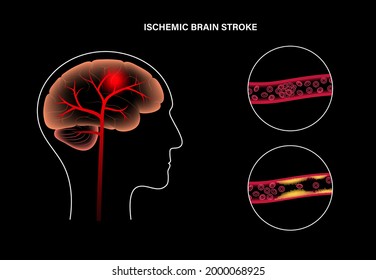 3,452 3d brain stroke Images, Stock Photos & Vectors | Shutterstock