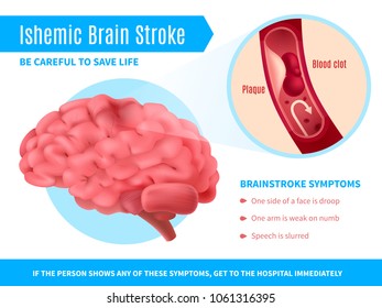 4,961 Cerebral stroke Images, Stock Photos & Vectors | Shutterstock