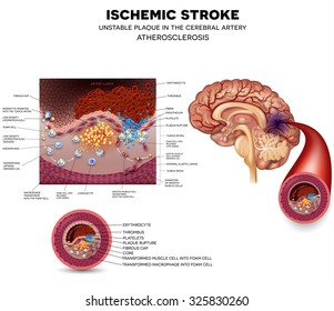 Ischemic Stroke In The Cerebral Artery. Unstable Plaque Formation And Thrombus.