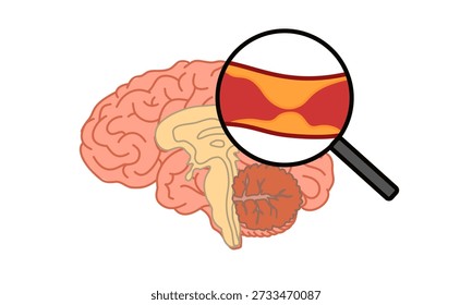 Concepto de ictus isquémico. Colesterol en los vasos sanguíneos humanos. Arteriosclerosis, infarto, isquemia, enfermedad de trombosis. bloqueado vascular, veta grasa, placa. Ilustración vectorial para médico.