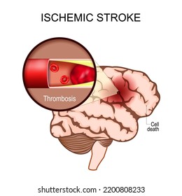 Ischemic Stroke. Human Brain. Close-up Of A Blood Clot In An Artery Resulting In Brain Death To The Affected Area. Thrombosis. Cerebral Infarction. Brain Ischemia. Vector Poster