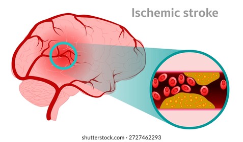 Los accidentes cerebrovasculares isquémicos ocurren cuando un coágulo de sangre bloquea un vaso sanguíneo en el cerebro. Sección transversal. Vector de ilustración
