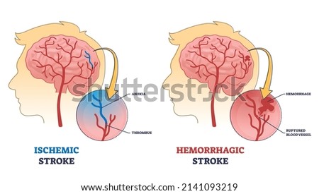 Ischemic vs hemorrhagic head stroke anatomical comparison outline diagram. Labeled educational scheme with medical brain clot, ruptured blood vessel and anoxia after thrombus vector illustration.