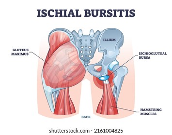 Bursitis isquial o diagrama de esquema de condición inferior del tejedor isquiogluteal. Esquema educativo etiquetado con inflamación muscular e ilustración portadora de bursa líquida. Anatomía de espalda del cuerpo humano.