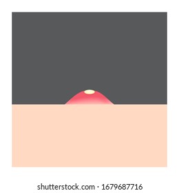 aislar icono plano acné en fondo gris