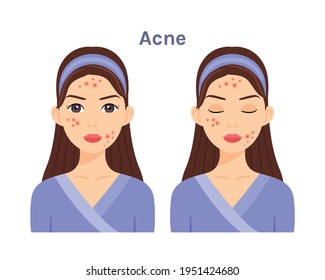 Isolated Beautiful Brunette Woman with Acne. Facial Skin Problems.Girl with open eyes and closed.White background. Color fashion flat illustration.Vector stock illustration.