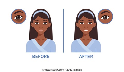 Isolated Beautiful Young Afro Woman with Dark Circles Under Eyes. Treatment of Skin Around Eyes. Icons Before After. Happy Lady. Healthy skin. Cartoon style. Image for Beauty, Medical Design. Vector.