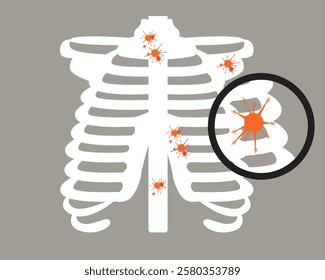 Isolated bone or skeleton with malignant tumor as oncology concept, flat vector stock illustration as bone cancer