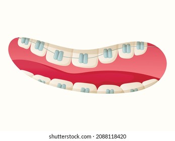 Isolated cartoon illustration of open mouth with teeth and dental braces.