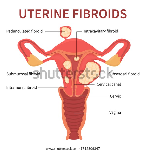 Isolated Flat Vector Illustration Uterine Fibroids Stock Vector