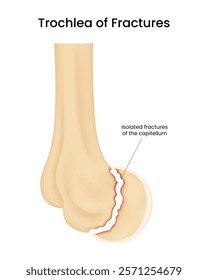 Isolated Fracture of the Capitellum