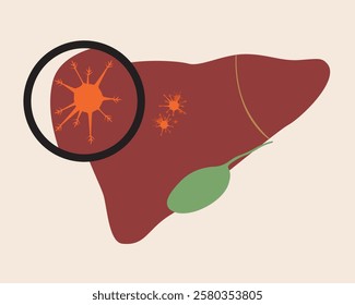 Isolated liver with malignant tumor as oncology concept, flat vector stock illustration as liver cancer