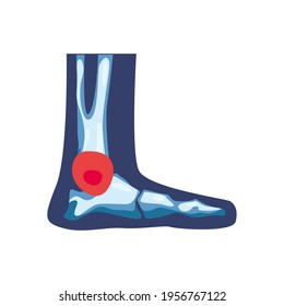 Isolated rheumatology blue foot bones