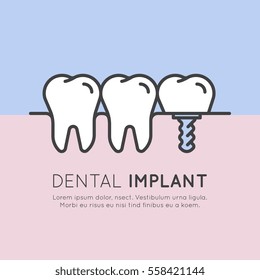 Isolated Vector Style Illustration Logo Badge or Dental Tooth Implant Installation Process, Aesthetics, Orthodontist