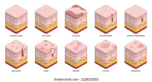 Isometric human skin types, 3d epidermis layers. Dermatology normal, oily and dry epidermis, skin structure problems, wrinkles, acne and rosacea flat vector illustration set. Epidermis layers