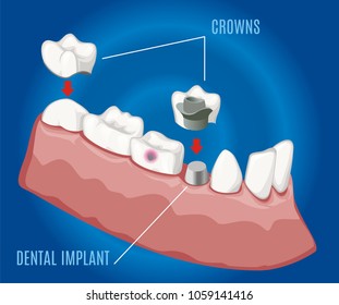 Isometric professional prosthetic stomatology template with dental implant and crowns on blue background isolated vector illustration