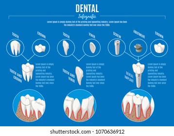 Isometric prosthetic dentistry infographic template with crown veneer and structure of dental implant vector illustration