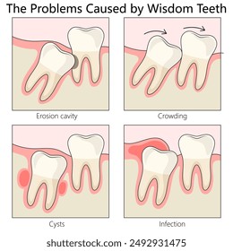 issues caused by wisdom teeth. Highlights dental problems and the need for treatment diagram hand drawn schematic vector illustration. Medical science educational illustration