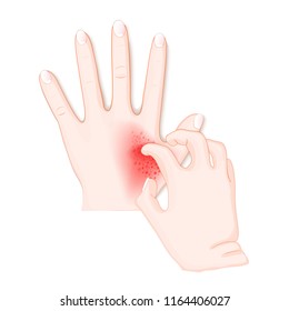 Itch. Human's Hands With Dermatitis. Vector Illustration For Biology, Scientific, And Medical Use.