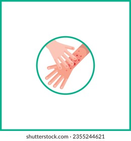 Itching on Hands Vector Illustration. Chicken Pox On Hands Vector. Rubbing Vector. Fungus On Hands. Hands Irritation and Inflammation Sign, Symbol. Tinea Manuum Vector. 