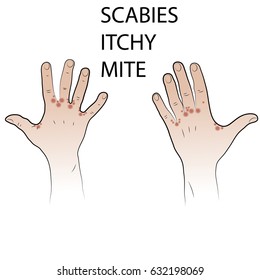 itchy mite. Brushes of hands, on which are located sores caused by an itch mite. . Hands affected by scabies mites. Colored vector illustration on the theme of lesions of the skin, itchy skin.