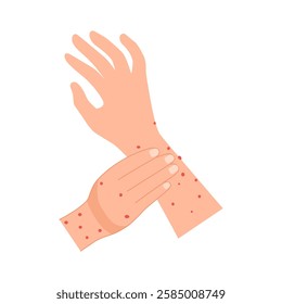 Itchy rash on arms and hands with red spots caused by severe viral infection. Skin disease caused by irritation from scratching from mosquito or insect bites. Vector illustration on white background.