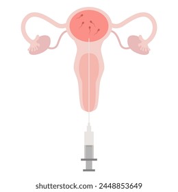 Tratamiento de IU, inseminación intrauterina, servicio de espermatozoides del donante. Ilustración con el óvulo, el espermatozoide es bueno para la clínica médica de póster. Inseminación intrauterina IIU