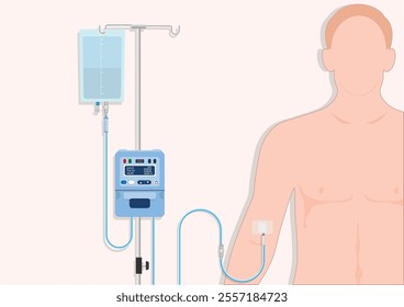 IV therapy or Intravenous therapy is a medical technique that administers fluids, medications and nutrients directly into a vein.Medical Infusion Pump IV Intravenous,Intermittent infusion, vector