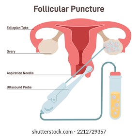 IVF. Follicular puncture, removing oocyte from the ovary of a woman, enabling fertilization outside the body. Artificial pregnancy with help of modern technology. Flat vector illustration