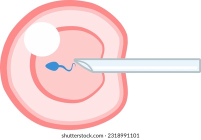 IVF ICSI vector illustration. Perfect for presenting anything about reproduction, insemination or ivf.