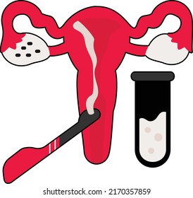 IVF TVOR Vektorfarben-Design, In-Vitro-Fertilisierungssymbol, Schwangerschaft und geburtshilfliches Zeichen, Babyprothese im Reagenzglas, Transvaginale Oozytenentnahme Konzept