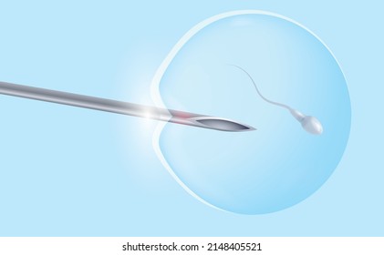 IVF, In Vitro Fertilization Of An Egg With A Sperm. A Medical Needle Implants The Sperm Into The Egg. Medical Poster. Vector Illustration