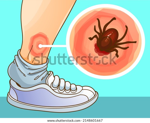 Ixodes Ricinus Deer Tick Tick Bite Stock Vector (Royalty Free ...