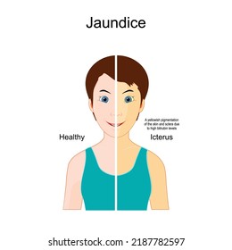 Jaundice. The Comparison between Healthy person and person with Icterus. yellowish pigmentation of the skin and sclera due to high bilirubin levels. health problems. vector illustration