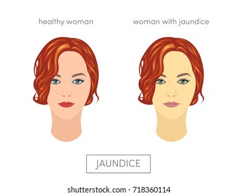 4,139 Jaundice Stock Illustrations, Images & Vectors | Shutterstock