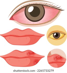 Jaundice disease vector concept illustration