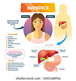 Jaundice icterus vector illustration. Labeled yellowish anatomical disease explanation scheme. Educational medical diagram with symptoms, causes, biliary tract and compared normal with pigmented skin.
