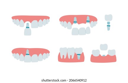 Jaw with healthy teeth and dental implant, dental bridge. Installation process and the scheme of the implant of a molar tooth, an incisor. Set of isolated vector illustrations in flat style