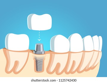 Jaw part model with teeth row and dental implant. Putting tooth crown on abutment. Dental implant and prosthetics fixture. Flat style vector visual aid illustration